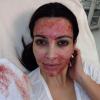 Любимата козметична процедура на Ким Кардашиян доведе до заразяване с ХИВ